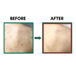 SOME BY MI AHA BHA PHA 30 Days Miracle Clear Body Cleanser (400ml) Results before and after